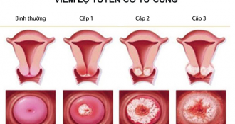 Viêm lộ tuyến cổ tử cung là gì? Nguyên nhân, biểu hiện và cách phòng ngừa bệnh